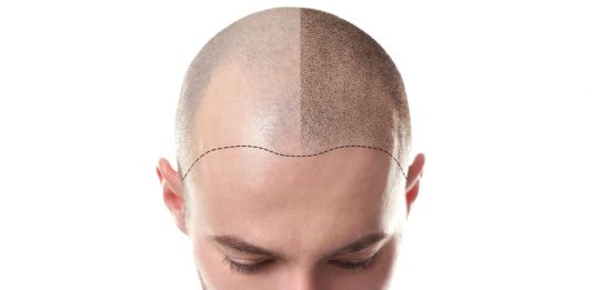 before and after bald man hair cure