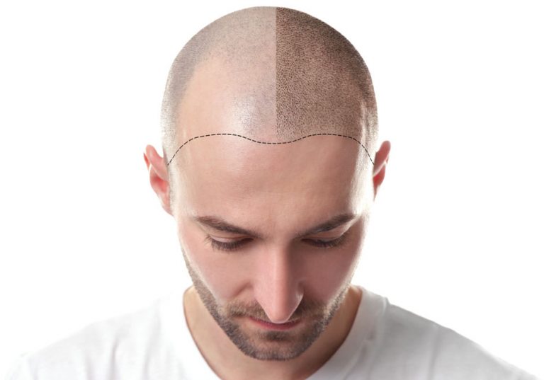 before and after bald man hair cure
